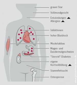 Cushing-Syndrom